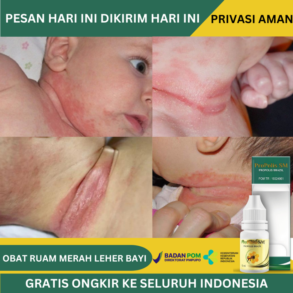 Obat Ruam Merah Di Lipatan Leher Bayi, Luka Berair, Lecet perih, Obat Bintik Bintik Merah Pada Bayi,