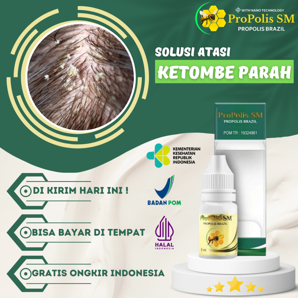 Obat Ketombe Parah, Obat Gatal Kepala Parah, Obat Penghilang Ketombe,Obat Borok Di Kulit Kepala - Ob