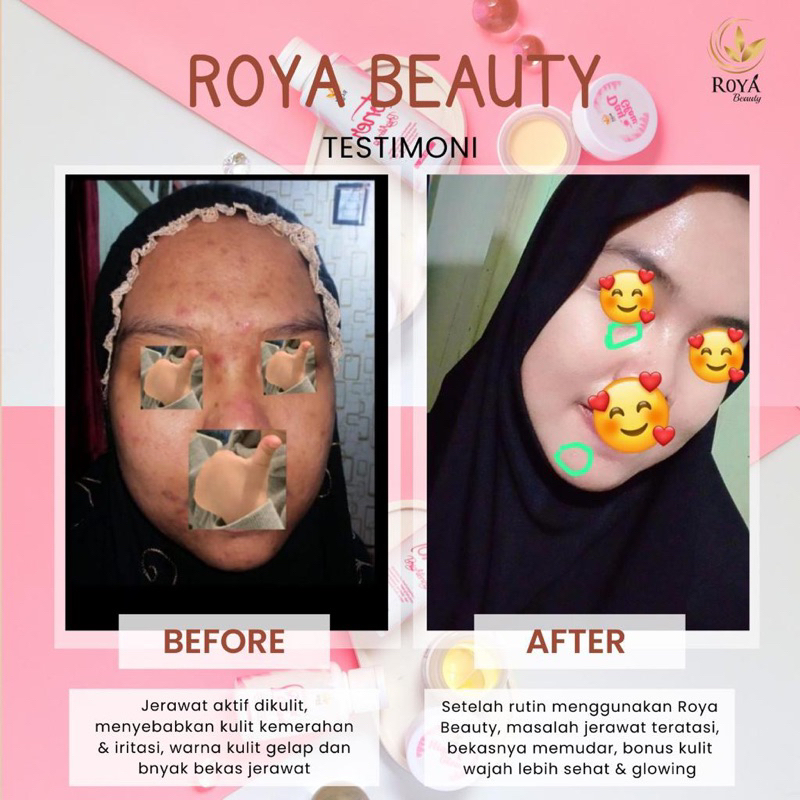 ROYA BEAUTY SKINCARE PEMUTIH WAJAH AMPUH MENGHILANGKAN JERAWAT DAN FLEK BANDEL (PAKET SIMPLE DAN HEM