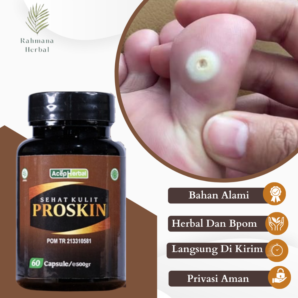 Obat Mata Ikan Di Telapak Kaki, Obat Salep Mata Ikan, Obat Clavus, Obat Perontok Mata Ikan, Obat Mat