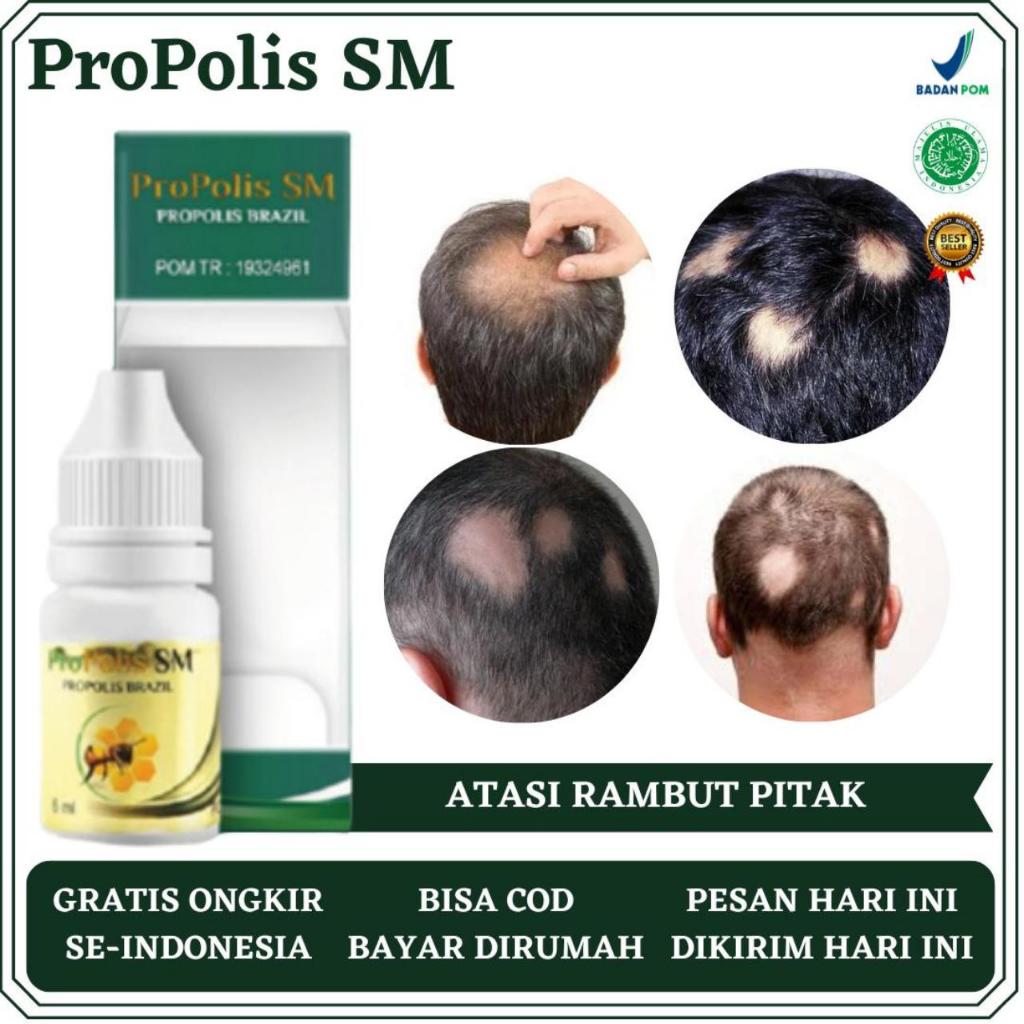 Obat Rambut Pitak, Obat Rambut Rontok, Obat Rambut Botak Koin, Obat Penumbuh Rambut Pitak, Obat Penu