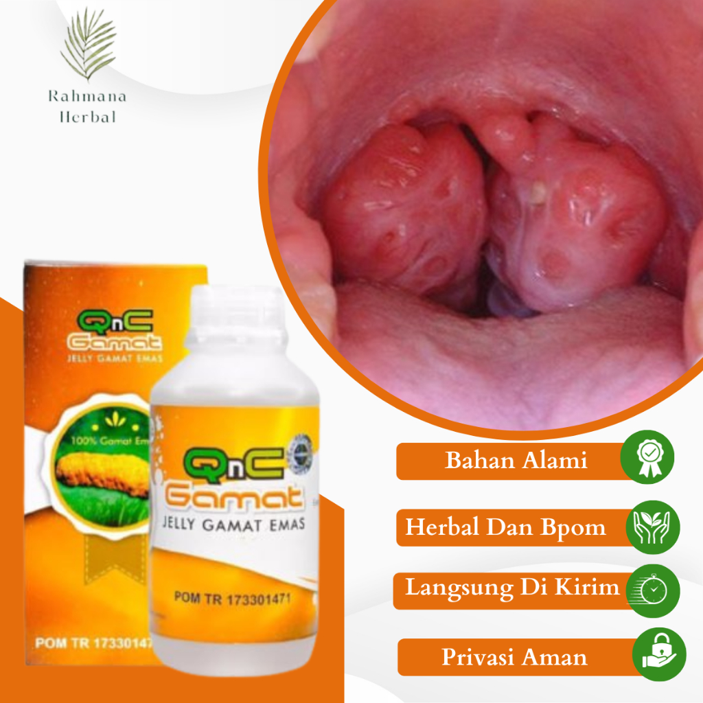 Obat Amandel, Obat Radang Amandel, Obat Amandel Bengkak, Obat Amandel Akut Dan Kronis, Obat Infeksi 