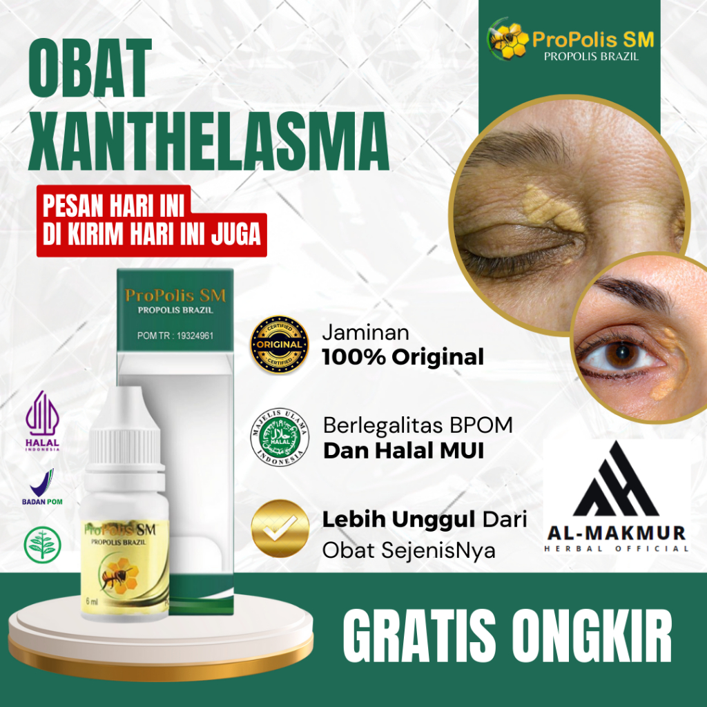 Obat Xanthelasma, Obat Penyakit Xanthelasma, Obat Gumpalan Lemak Di Kelopak Mata, Obat Penghilang Fl