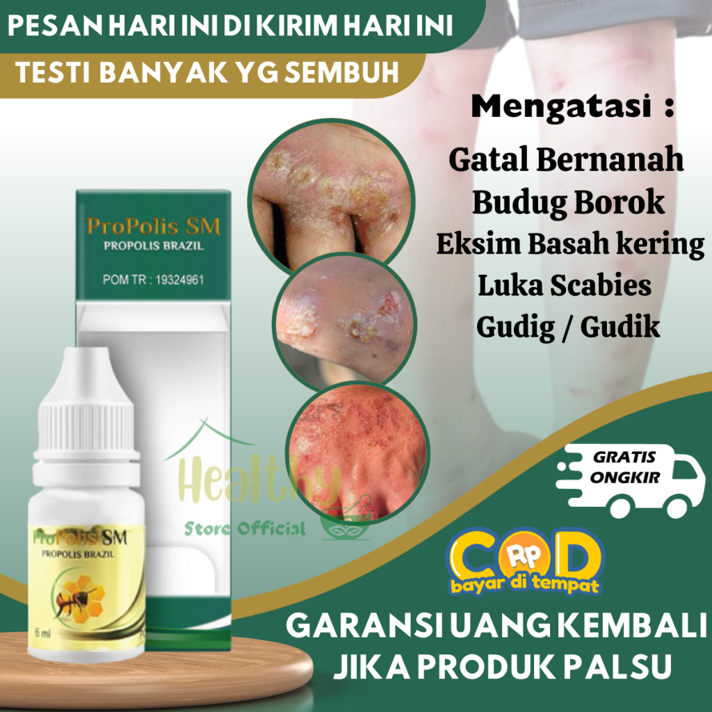 Obat Kulit Borok Bernanah, Obat Tetes Kulit Borok Korengan , Obat Budug Di Kaki, Obat Budug Santri, 