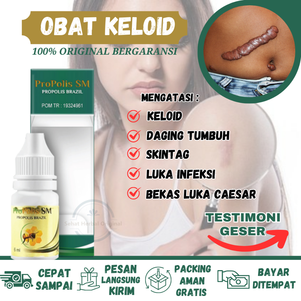 Obat Keloid Bekas Caesar, Penghilang keloid Bekas Operasi, Obat Keloid Bekas sayat, Obat Keloid Beka
