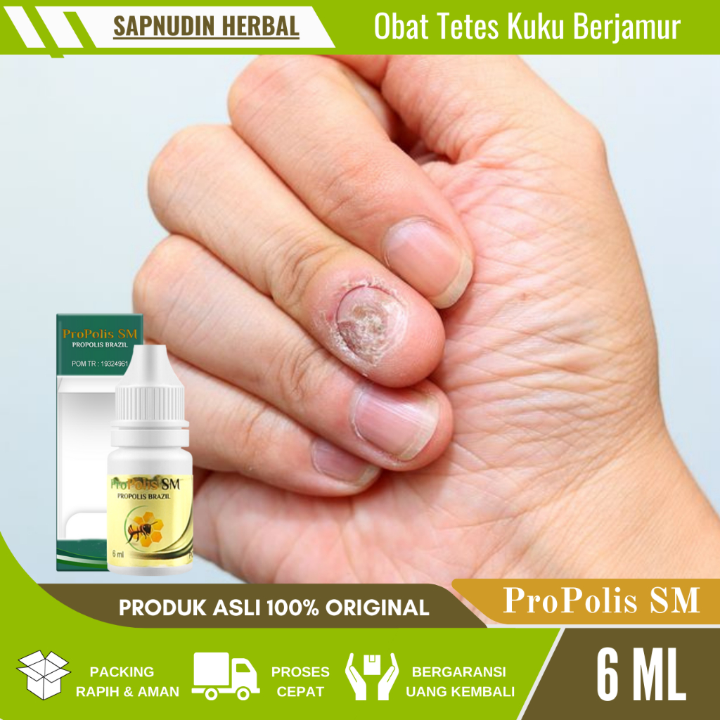 Obat Tetes Kuku Berjamur, Obat Jamur Kuku, Obat Kuku Rusak, Obat Kuku Kering, Obat Kuku Kuning, Obat