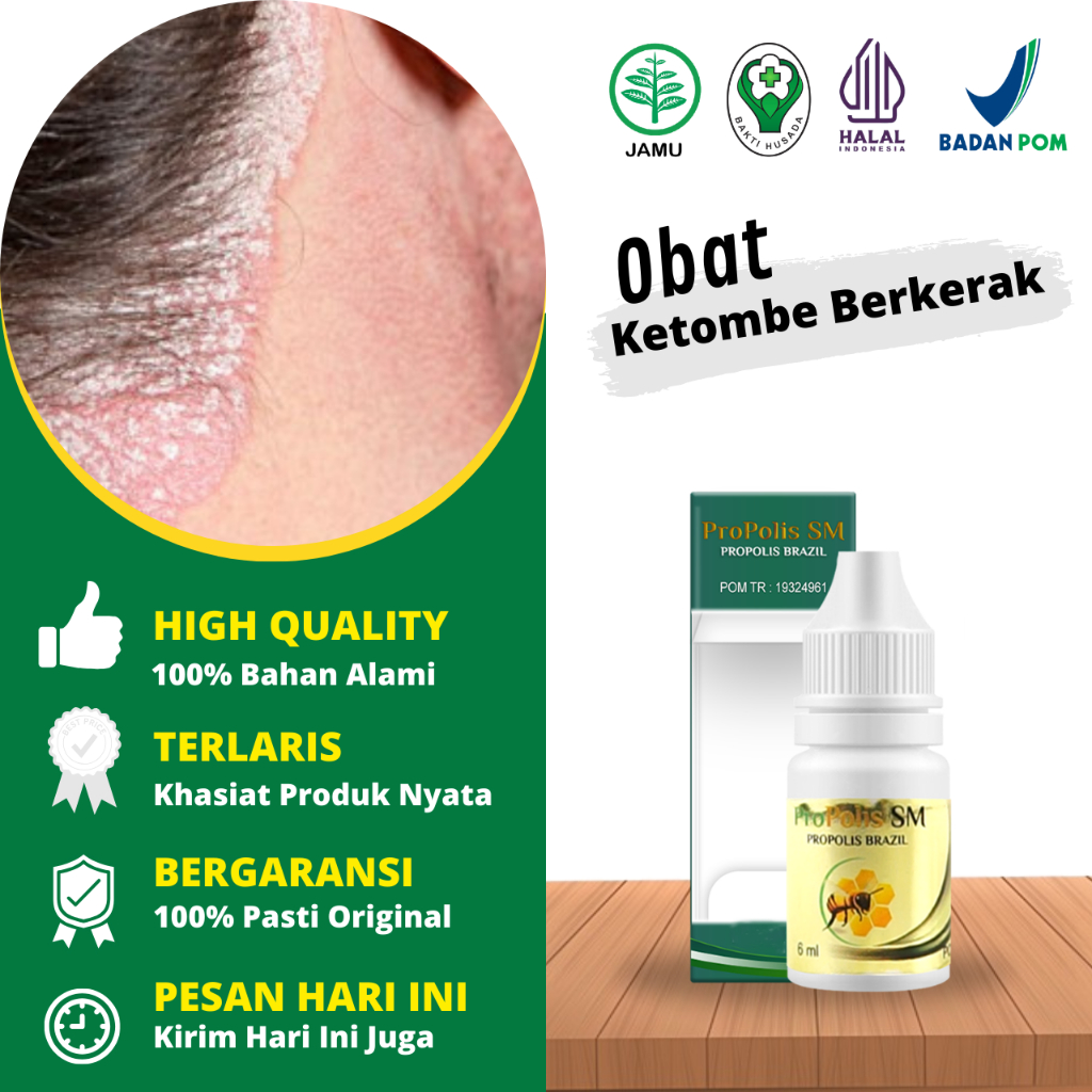 Obat Ketombe Berkerak Di Kulit Kepala, Obat Jamur Kulit Kepala, Obat Ketombe Psoriasis, Salep Borok 
