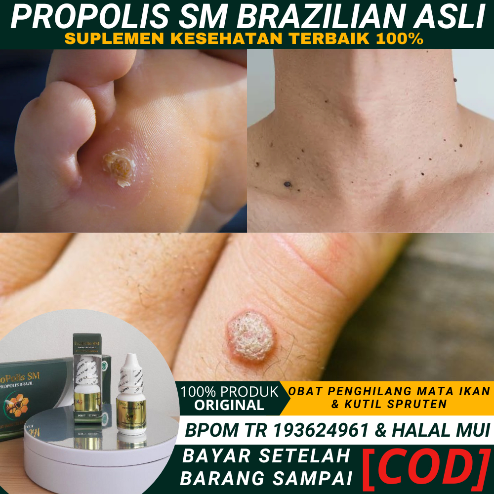 Cara Menghilangkan Mata ikan, Kutil, eksim, jamur kulit, Spruten dan Kapalan, obat menghilangkan mat