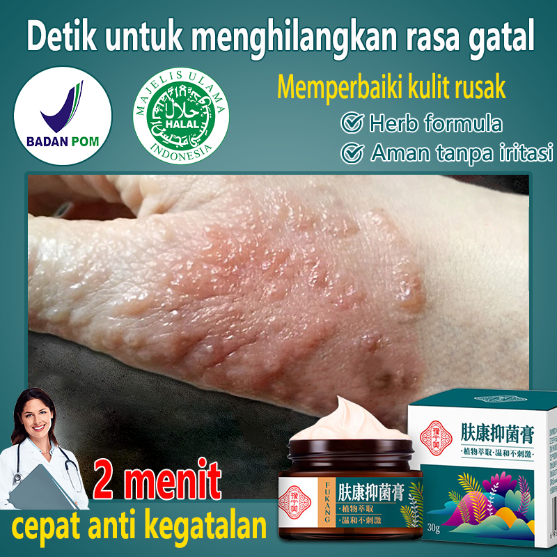 (100% ORI)Obat alergi gatal kulit Salep gatal paling ampuh Salep psoriasis 30g Obat gatal/Obat gatal