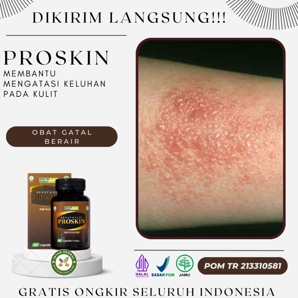 Proskin - Obat Gatal Berair, Gatal Berair Di Jari Tangan Dan Kaki, Kutu Air, Bintik Bernanah, Cenang
