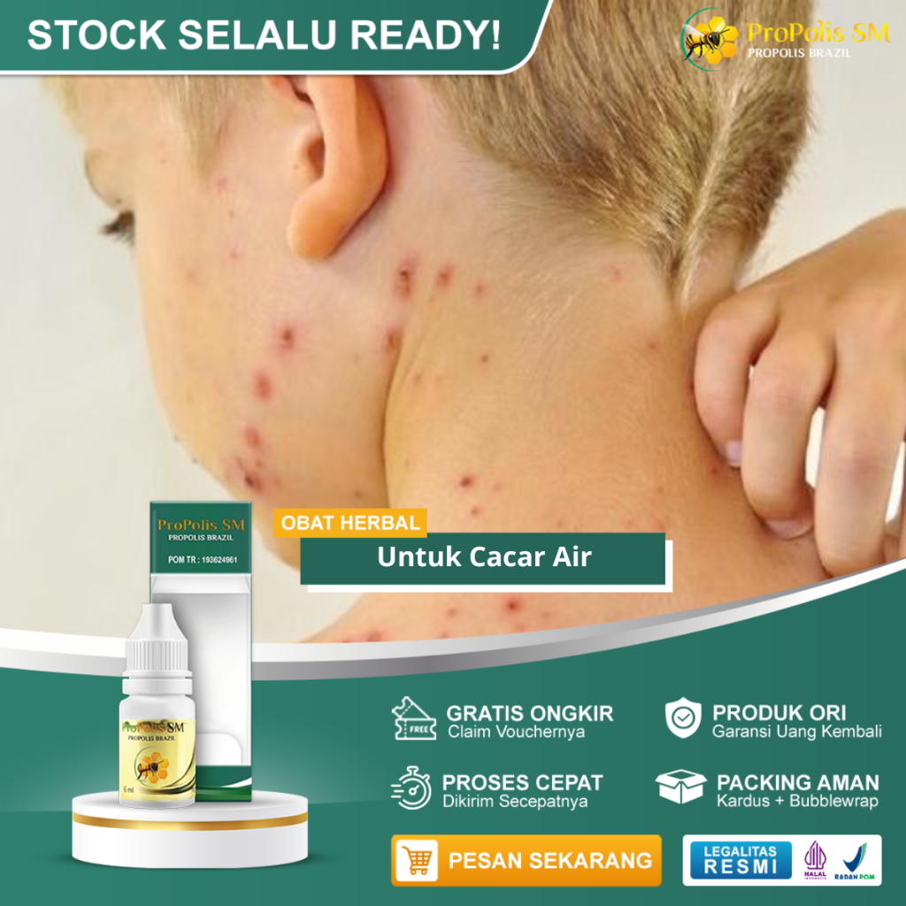Obat Penghilang Bekas Cacar Air Pencegah Cacar air Gatal Kulit Cacar Api Kulit Bintik Berair Pencega
