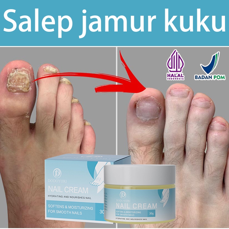 [BPOM]Obat kuku jamur dan rusak Obat Jamur Kuku 30g Serum kuku jamur dan rusak obat kuku rusak palin