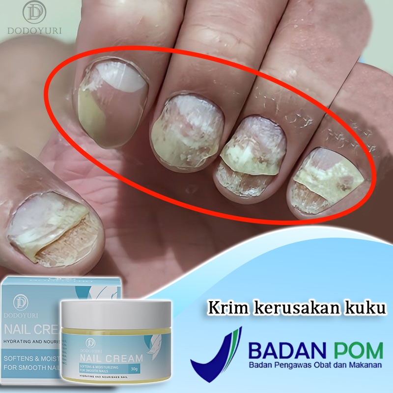 【BPOM】Serum kuku jamur dan rusak obat kuku jamur dan rusak obat jamur kuku 30g obat kuku rusak palin
