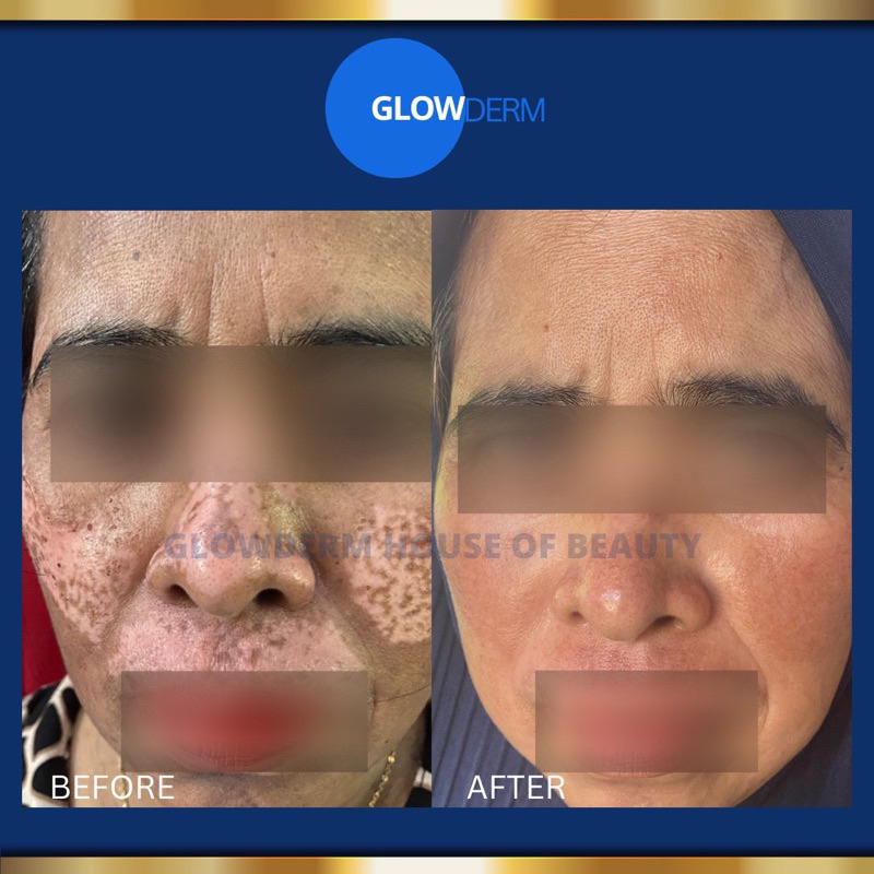 PAKET BRIGHTENING GLOWDERM