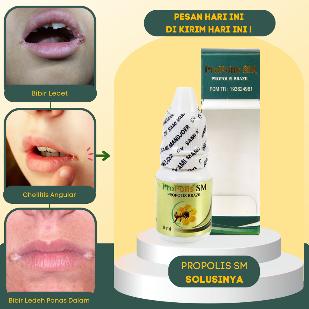 Obat Cheilitis Angular Luka di sudut bibir - Obat Pengering Luka di Ujung2 Bibir - Obat Ujung Bibir 