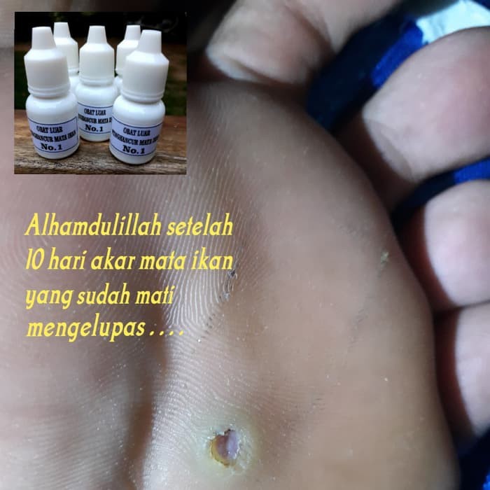 【100% Original】 Obat Mata Ikan Telapak Kaki dan Tanagan Callusol - Obat Mata ikan,Kutil,Kapalan | Ob