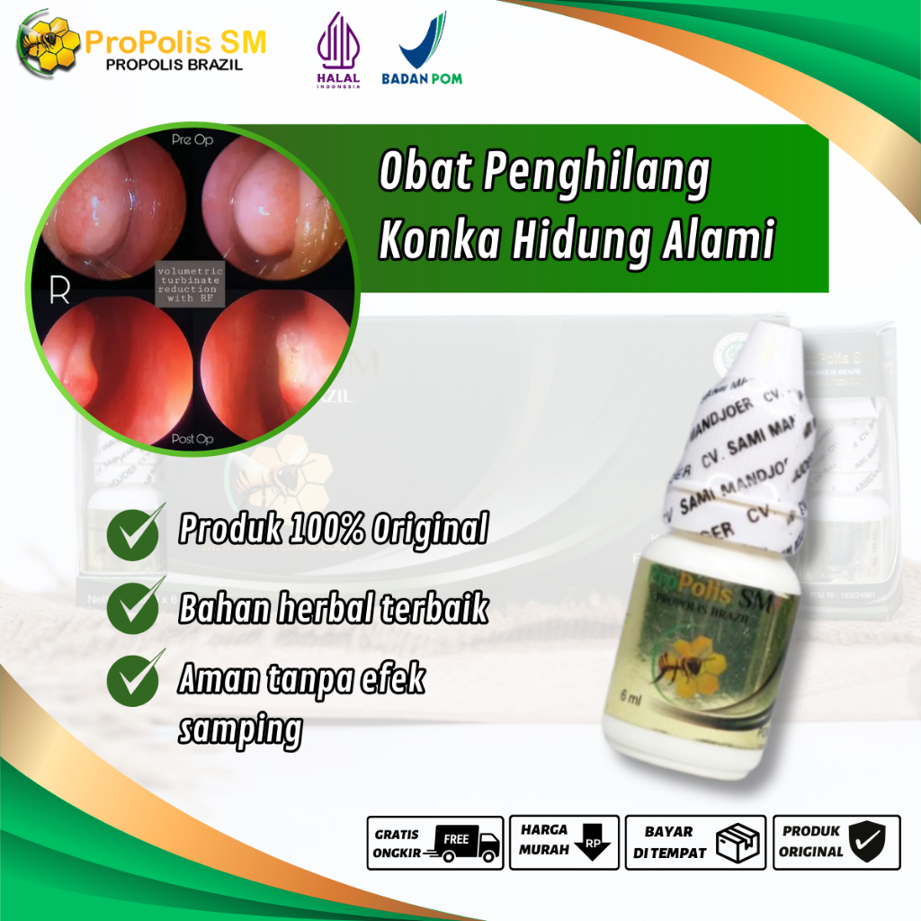 Obat Konka Hidung, Konka Hidung Membesar, Benjolan Dalam Hidung, Pembengkakan Konka, Hipertrofi Konk