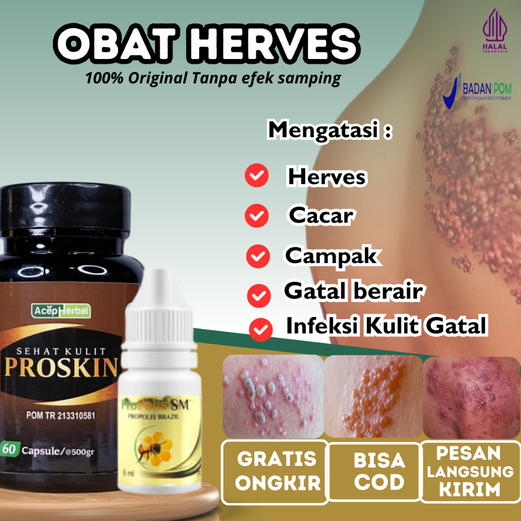 Obat Herpes Zoster, Obat Herpes kulit, Obat herpes bibir, Obat herpes Genital / Herpes Kelamin, Sale