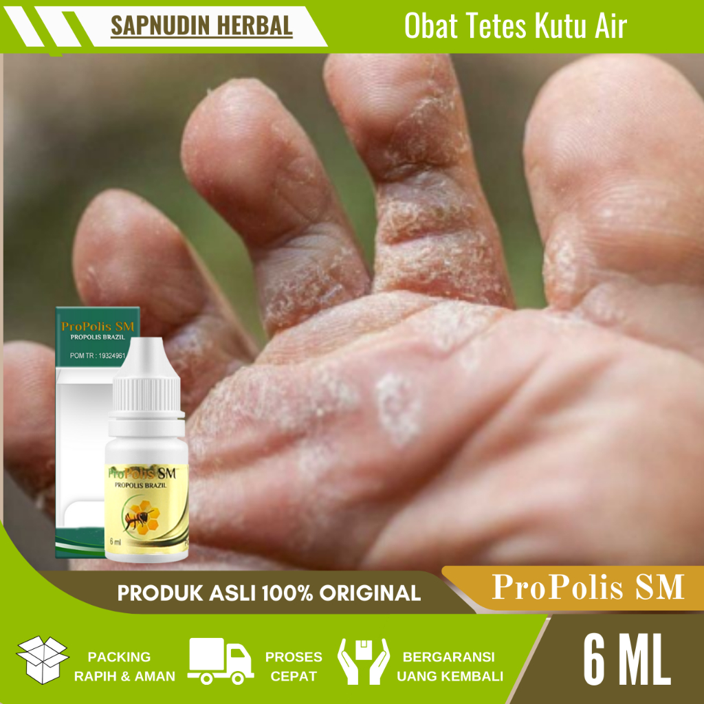 Obat Tetes Kutu Air Di Jari kaki, Obat Gatal Berair Di Jari Tangan Dan Kaki, Obat gatal Berair Di Ta