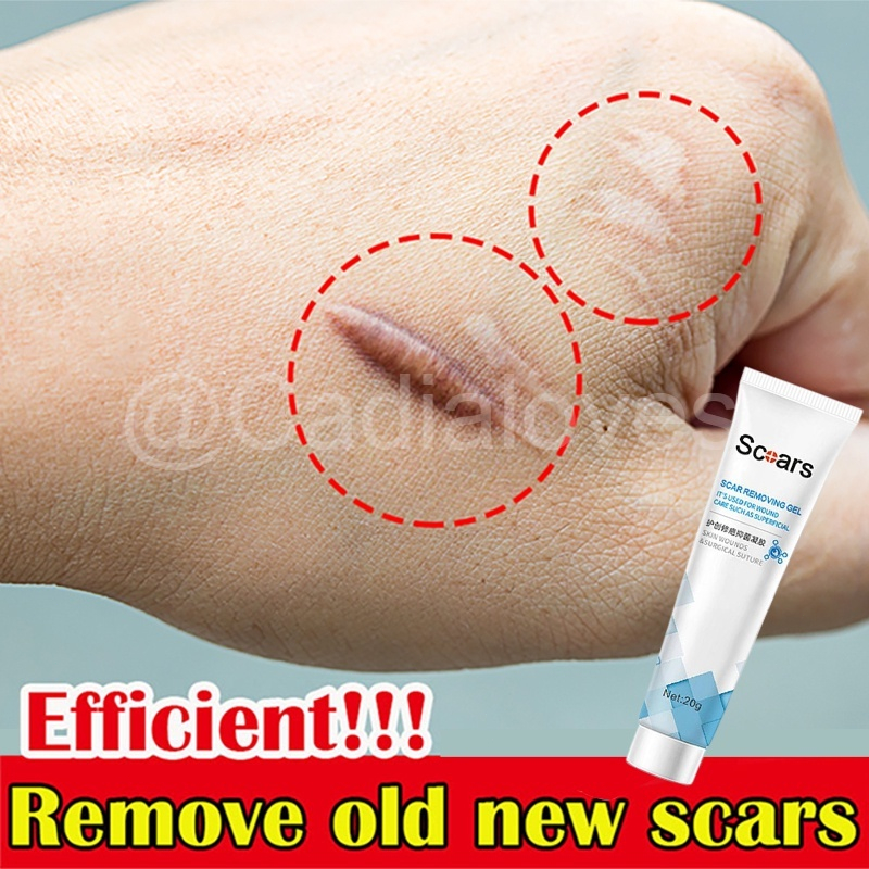 【Ori】Obat Penghilang Bekas Luka Lama Hitam Koreng Bakar Knalpot Jerawat Operasi Scar Keloid Selulit 