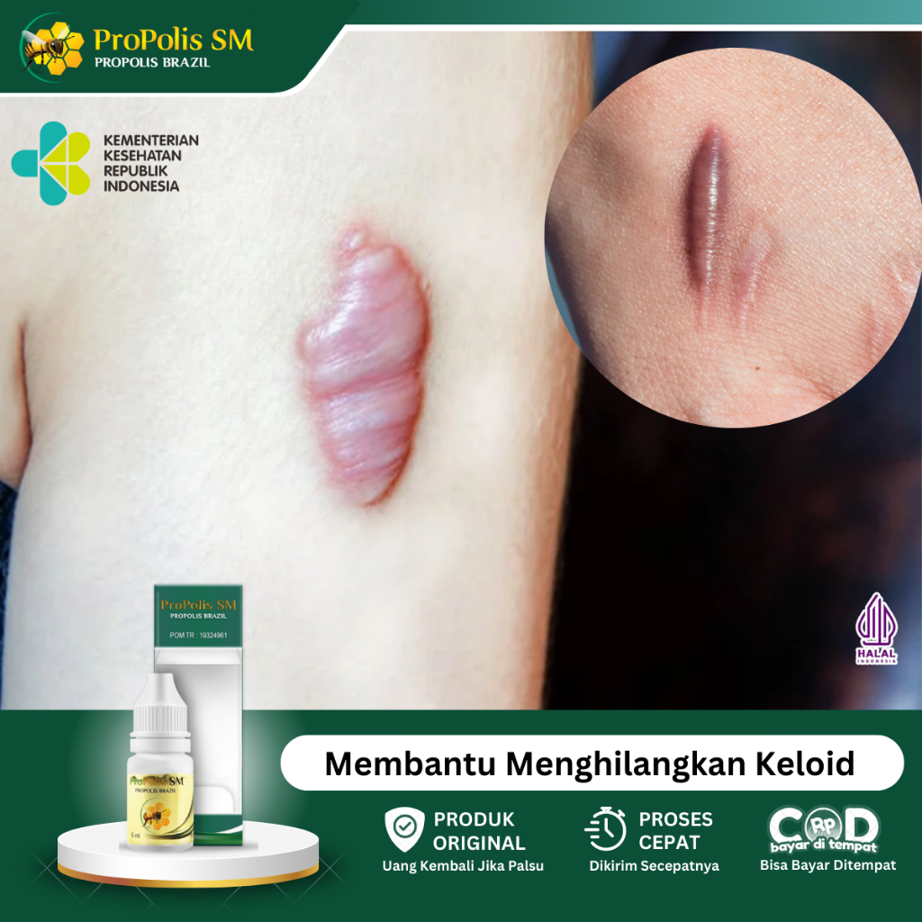 Obat Keloid, Obat Keloid Daging Tumbuh, Obat Keloid Menahun, Obat Penghilang Keloid Daging Tumbuh, O
