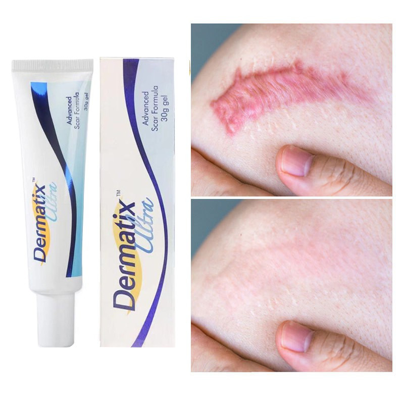 Dermatix Ultra Cream 15gr Penghilang Bekas Luka Operasi Keloid - Luka Lama - Bakar - Gatal Koreng De