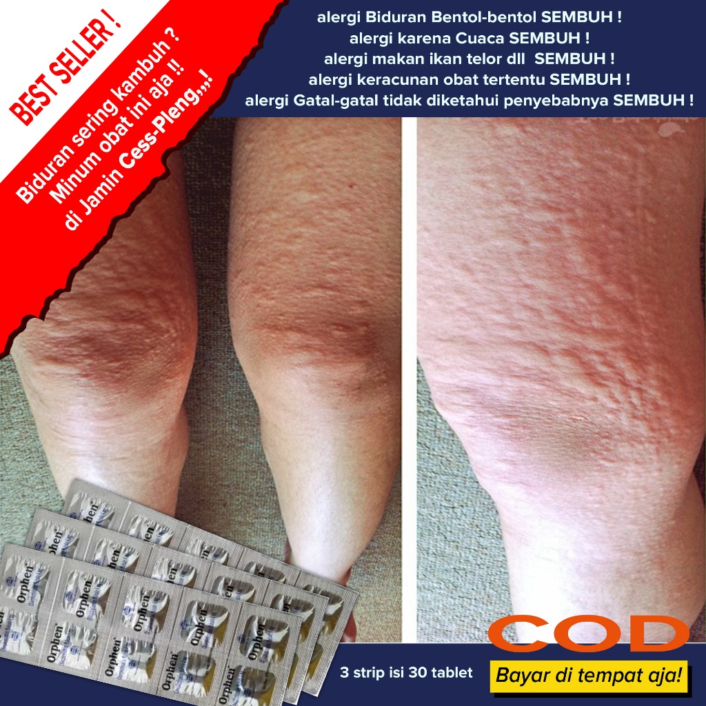 Best seller Obat gatal Bidur obat biduran AMPUH Murah Mengbati gatal bentol bentol gatal biyang keri