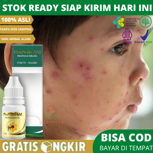 Obat Menghilangkan Bopeng Bekas Cacar, Obat Salep Cair Untuk Cacar Air Anak / Dewasa, Obat Menghenti