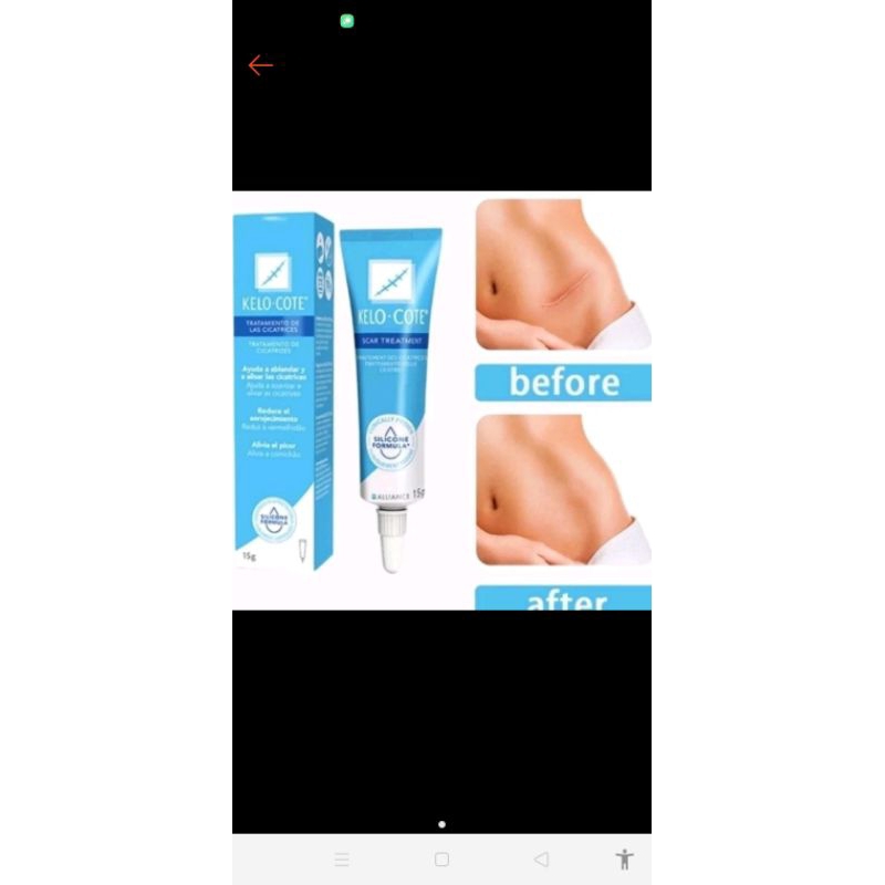 penghilang bekas luka jahitan.