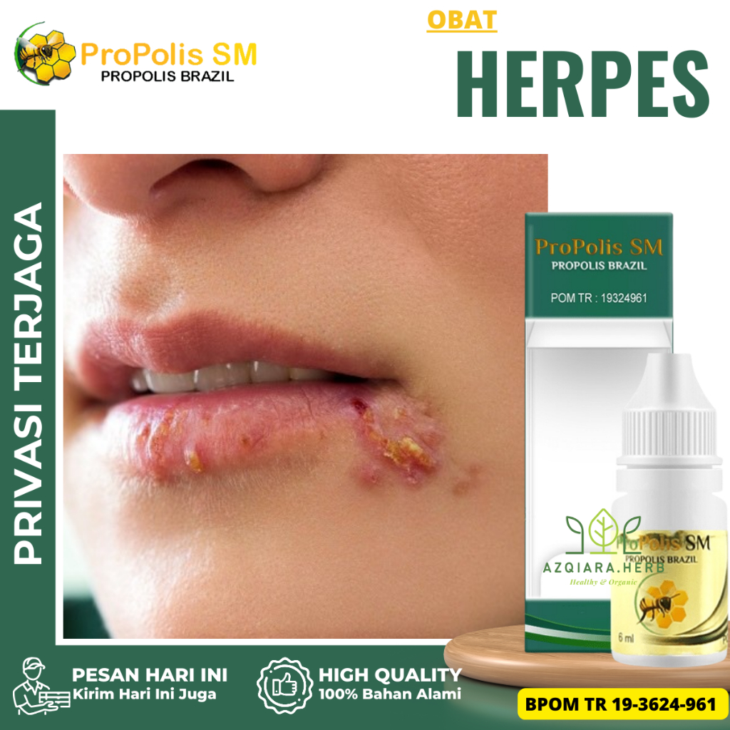 Obat Herpes, Obat Herpes Kulit, Obat pereda Nyeri Herpes Zoster, Obat Gatal Bekas Herpes, Obat Herpe