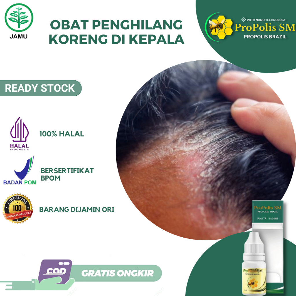 Obat Koreng di Kepala Borok Jamur Kulit Kepala Kulit Kepala Berkerak Bersisik Gatal Kulit Kepala Pso