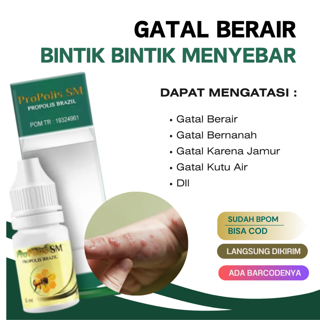 Propolis SM - Obat Gatal Berair Di Jari Tangan Dan Kaki Anak Dan Dewasa - Obat Gatal Berair Menyebar