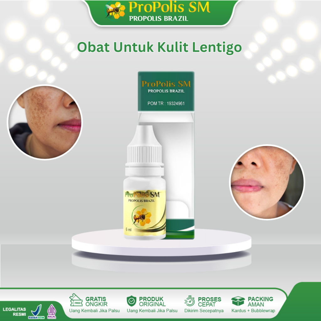 Obat Kulit Lentigo Bintik Hitam Di Wajah Bintik Cokelat Di Kulit Bintik Cokelat di Permukaan Kulit W