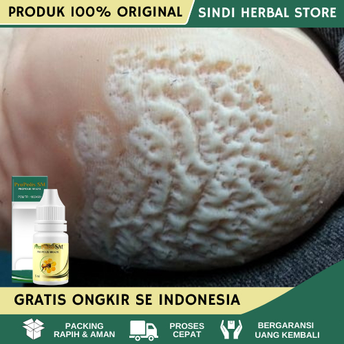 Obat Kaki Rayapan, Obat Penghilang Rayapan, Obat Kaki Berlubang, Obat Kaki Rayapan dan Bau, Obat Kak