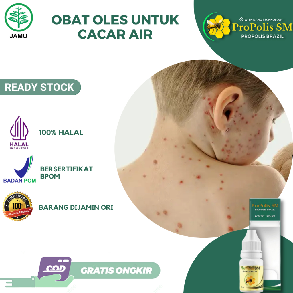Obat Cacar Air Ruam Gatal Berair di Kulit Cacar Air di  Badan & Wajah Tampek Obat Penghilang Bekas C
