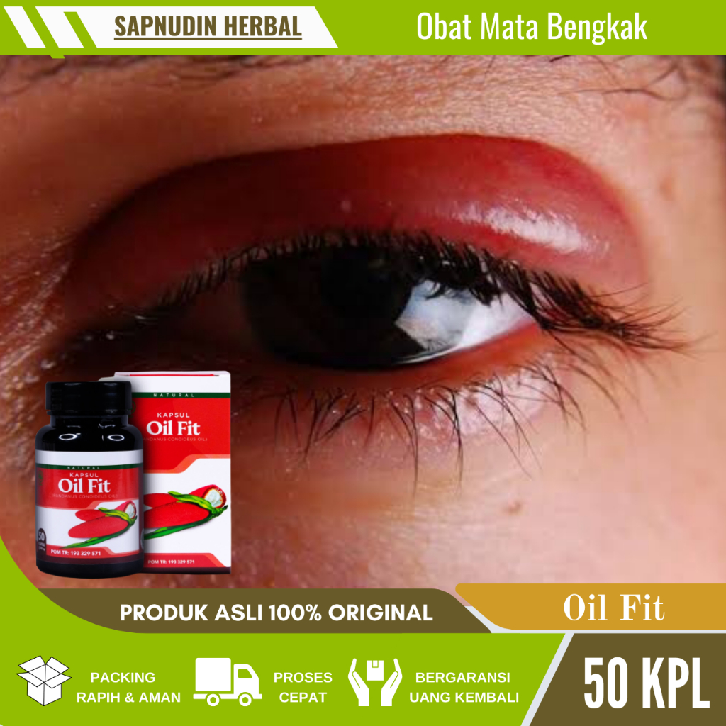 Obat Mata Bengkak, Obat Kelopak Mata Bengkak, Obat Radang Kelopak Mata, Obat Mata Ada Penumpukan Cai