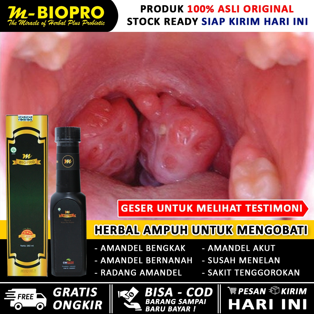 Obat Amandel Anak Dewasa Ampuh Tanpa Operasi MBIOPRO , Amandel Bengkak, Radang Tenggorokan, Amandel 