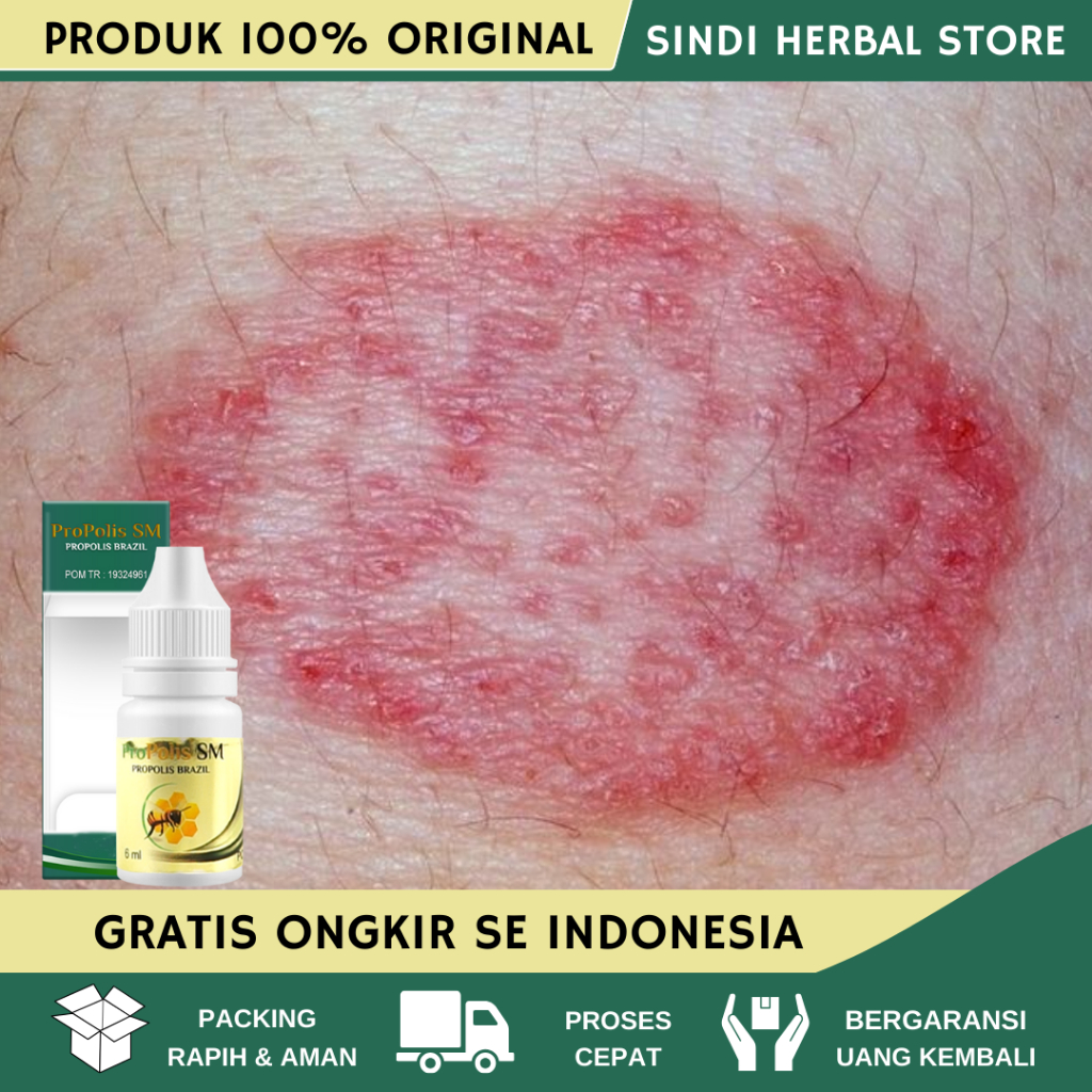 Obat Gatal Pantat - Obat Penghilang Gatal Di Pantat - Obat Kurap Gatal Pantat - Obat Pantat Burik - 