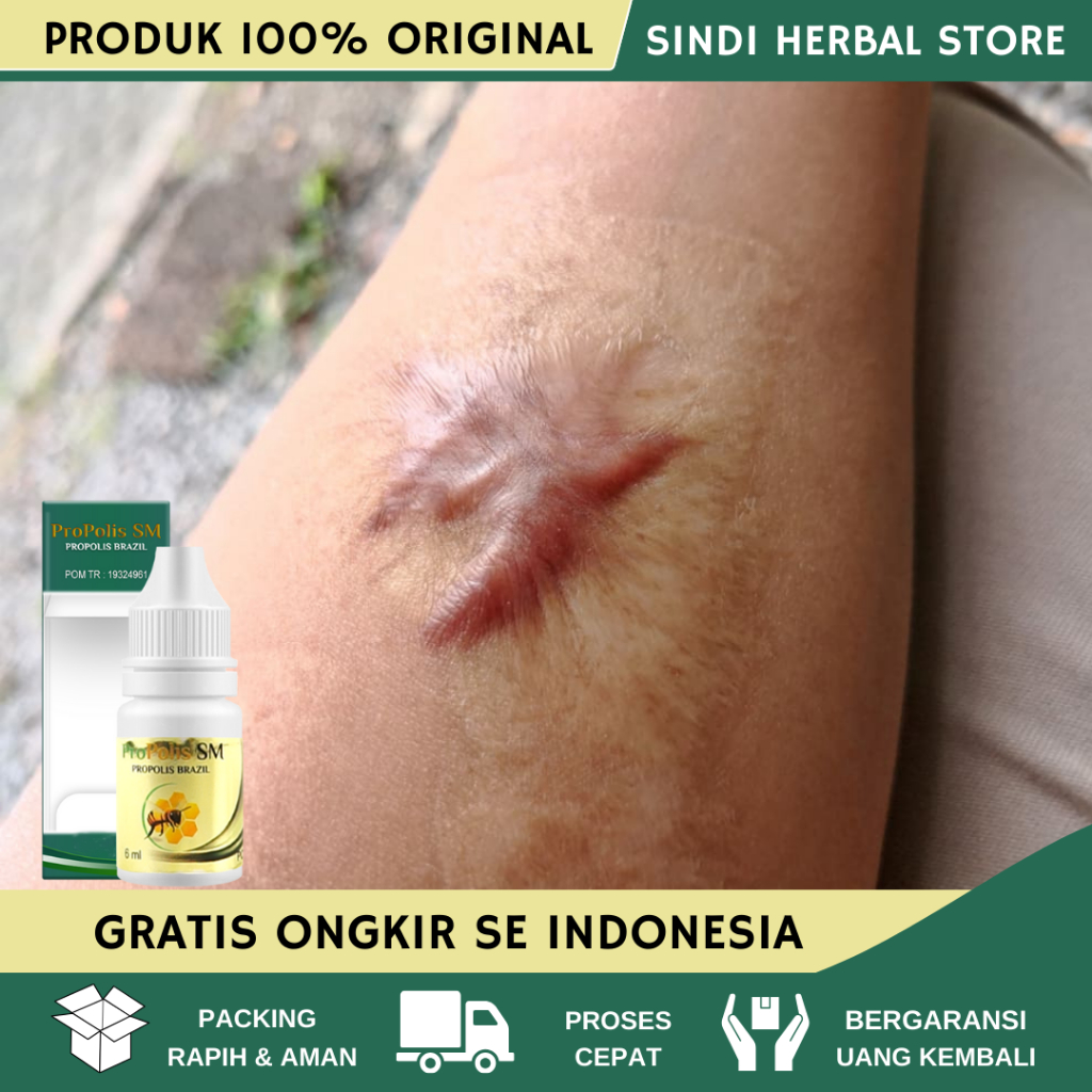 Obat Keloid Daging Tumbuh, Penghilang Keloid Daging Tumbuh, Keloid Bekas Operasi, keloid Luka tindik