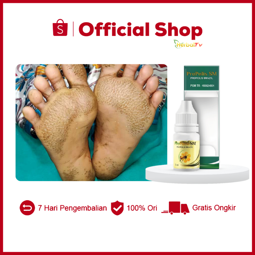 Obat Kaki Rayapan Obat Kaki Berlubang Obat Kaki Bolong Obat Kaki Pecah Pecah Obat Kaki Jamuran