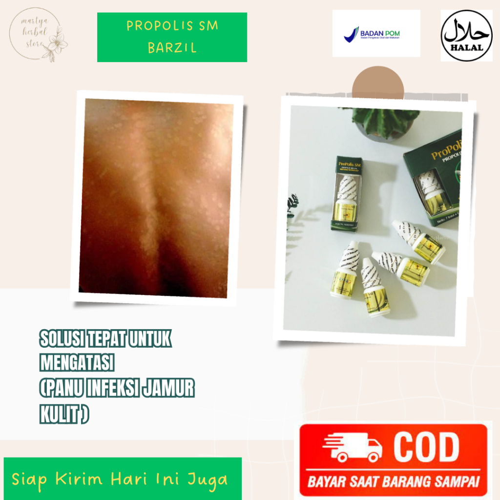 Obat Panu Cair, Obat Jamur Kulit Panu, Obat Panu Di Wajah Obat Panu Di Punggung, Obat Infeksi Jamur 