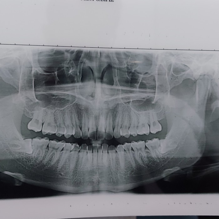 

YC Paper (Film Inject A4 untuk CR/DR Radiologi Film)