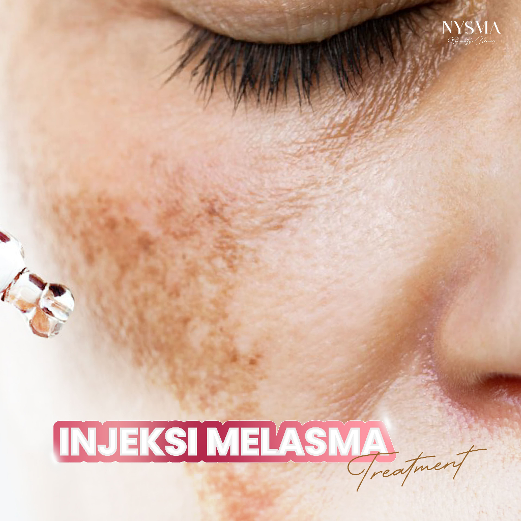 NYSMA Injeksi Melasma | Inject Treatment
