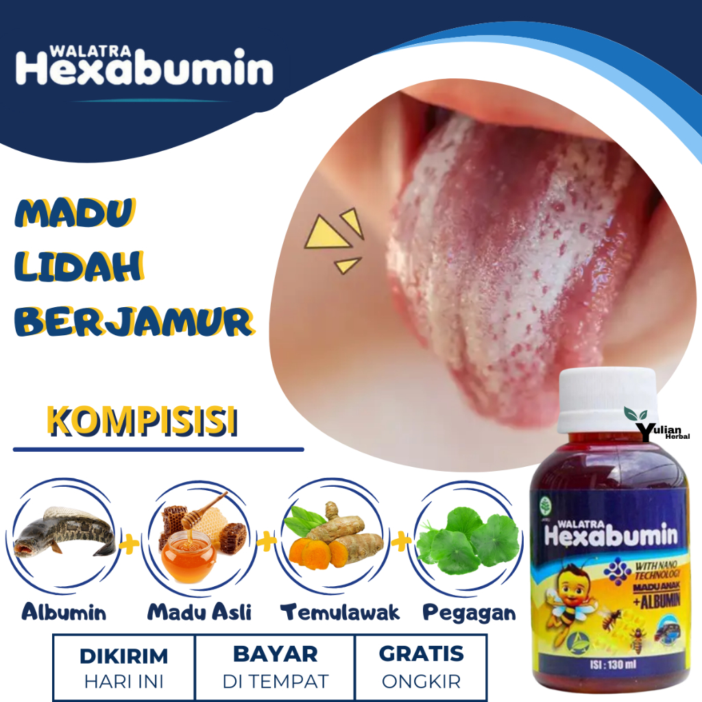 Obat Jamur Di Lidah Anak, Obat Lidah jamuran Anak,  Obat Candidiasis Lidah, eObat Lidah Putih, Obat 