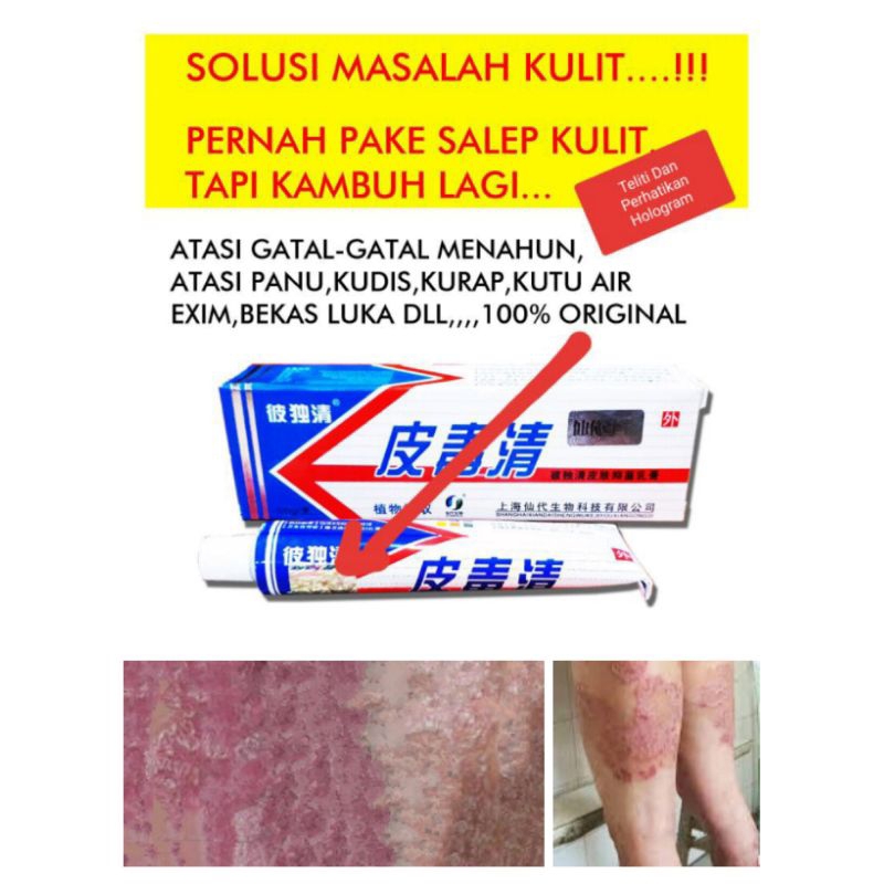 Salep gatal gatal SHINSE Menahun Panu Kudis Kurap Exim Bekas Luka lenyap