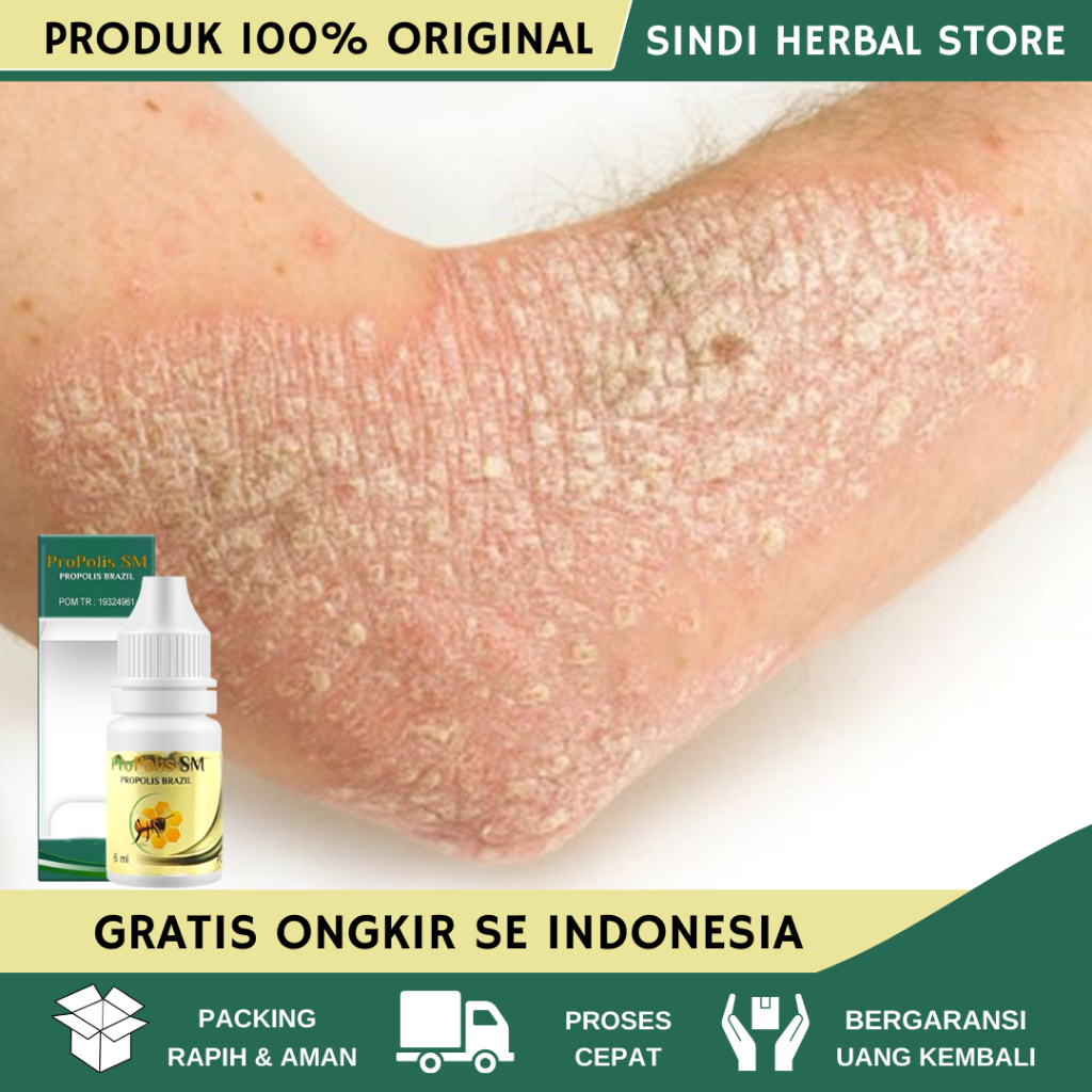 Obat Eksim, Obat Gatal Eksim, Obat Gatal Exim Kering Menahun, Obat Untuk Gatal2 Kering, Obat Gatal M