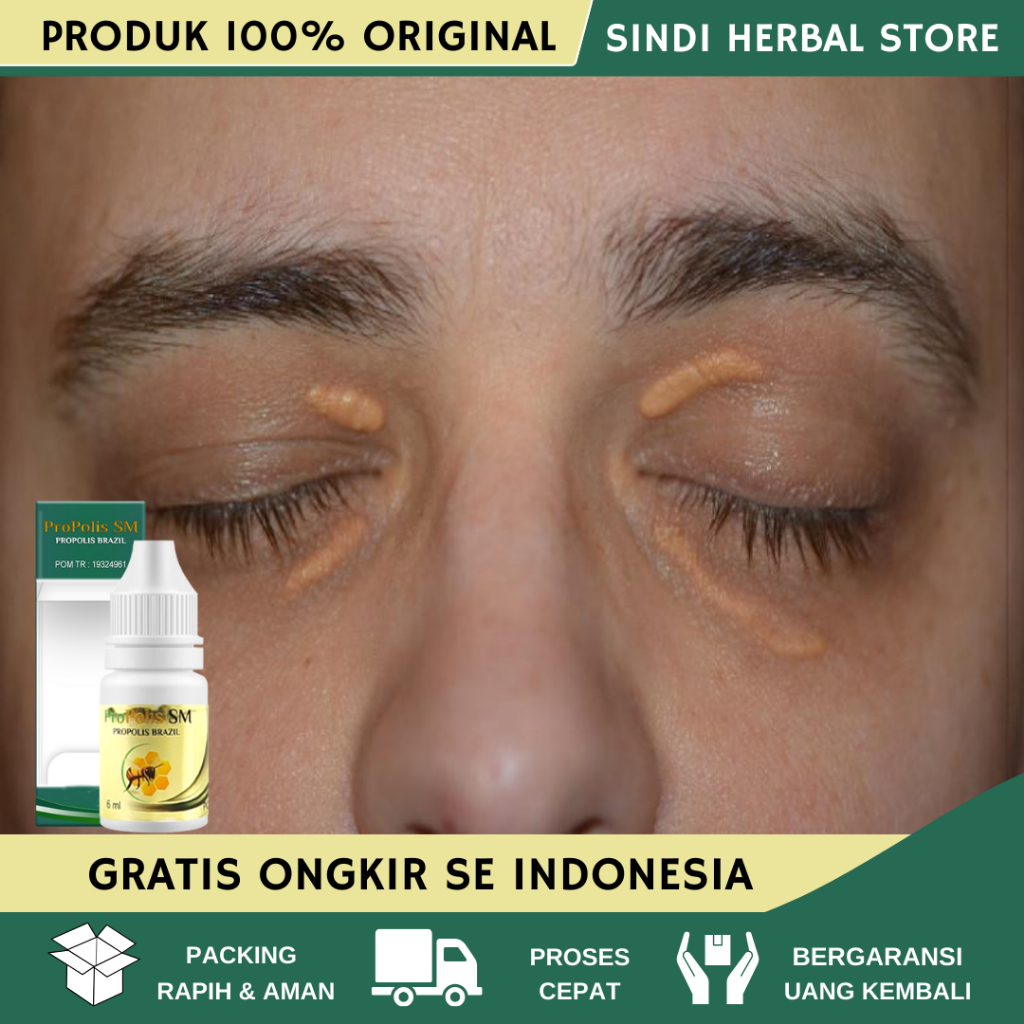 Obat Xanthelasma, Obat Xanthelasma Santelasma, Obat Herbal Mata Xanthelasma, Obat Penghilang Gumpala