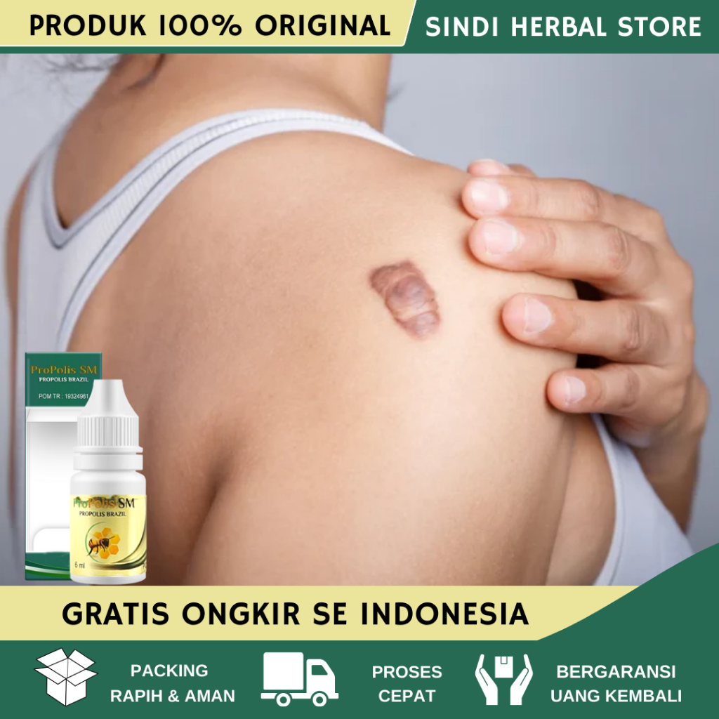 Obat Keloid, Obat Keloid Menahun, Obat Keloid Luka Tindik, Obat Keloid Tahunan, Obat Keloid Daging T