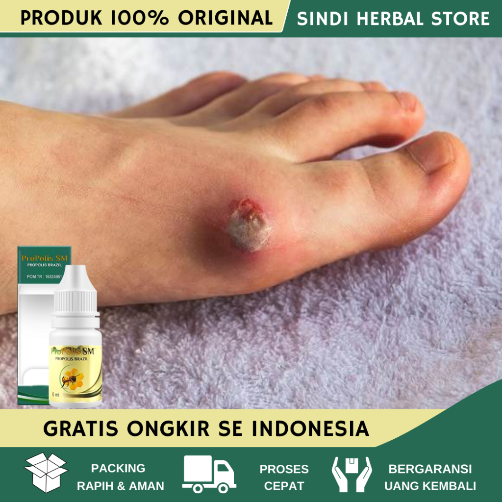 Obat Luka Diabetes, Obat Luka Diabetes Agar Cepat Kering, Obat Pengering Luka Gangren Diabetes Melit