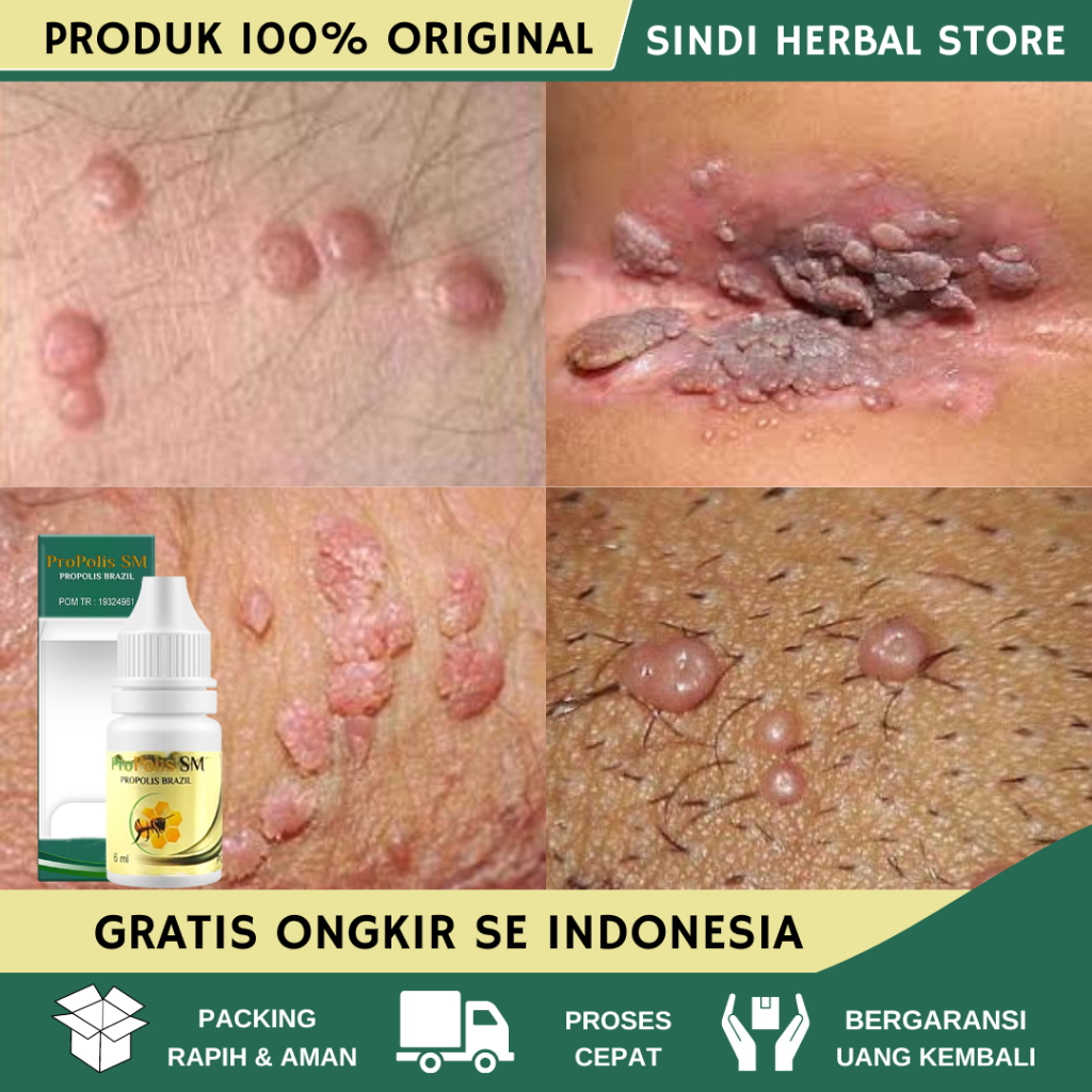 Obat Kutil Kelamin, Obat Kutil Kelamin Laki Laki, Obat Kutil Kelamin Wanita, Obat Kutil Kelamin HPV